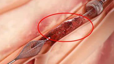 已形成深靜脈血栓者治療措施及研究進(jìn)展