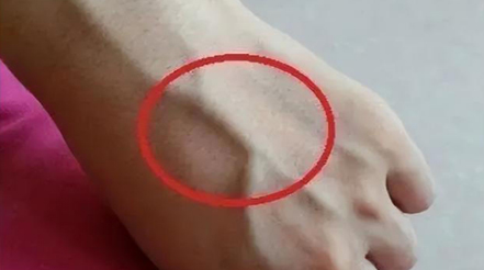 有人手臂上“青筋暴起”，有人卻看不到“青筋”，這是咋回事？