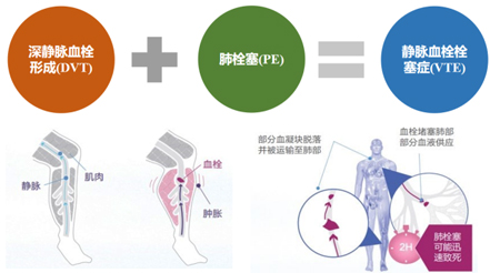 躺著也能防血栓？神經(jīng)肌肉電刺激來幫忙
