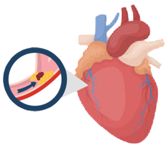 血栓是心梗、腦梗的元兇，很容易找上這些人