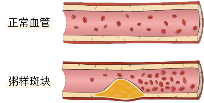 血栓是心梗、腦梗的元兇，很容易找上這些人