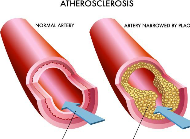 老年人如何預防下肢靜脈血栓 哪些癥狀提示下肢靜脈有血栓了 老年人如何預防下肢靜脈血栓 哪些癥狀提示下肢靜脈有血栓了