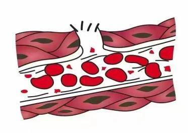 老年人如何預防下肢靜脈血栓 哪些癥狀提示下肢靜脈有血栓了 老年人如何預防下肢靜脈血栓 哪些癥狀提示下肢靜脈有血栓了