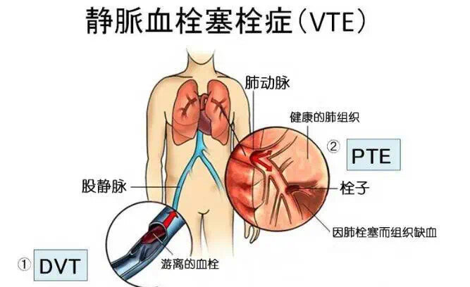 腎病綜合癥的VTE預(yù)防 腎病綜合癥的VTE預(yù)防