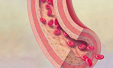 血栓形成，三個要素細分說