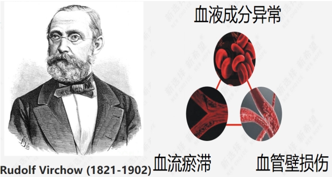 深靜脈血栓(VTE)的前世——血栓形成的三大危險因素 深靜脈血栓(VTE)的前世——血栓形成的三大危險因素